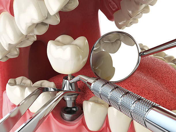Best Emergency Tooth Extraction in West Lake Hills, TX